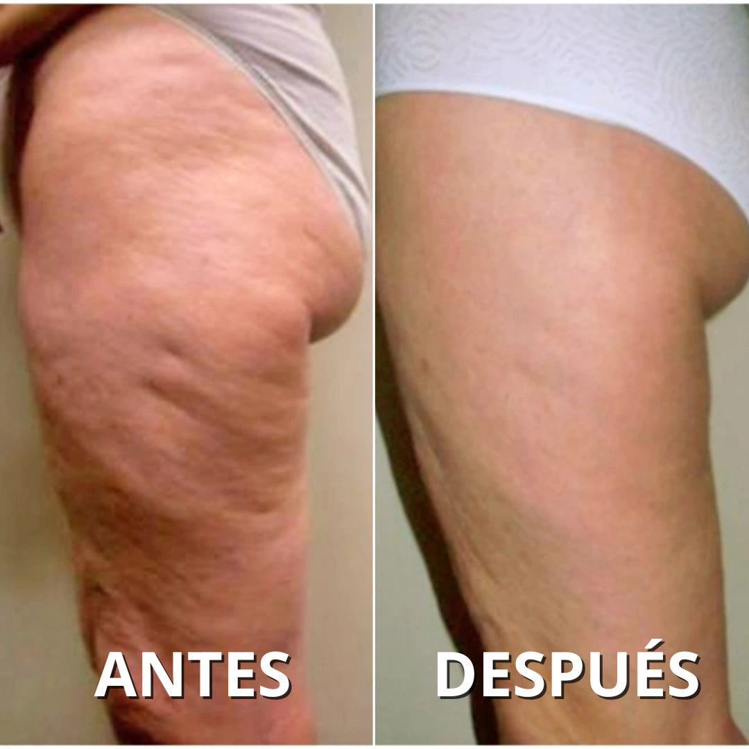 Dermaflux™ – Elimina la celulitis y reafirma tu piel desde casa. *(Oferta Pre-Verano) +Envío GRATIS.