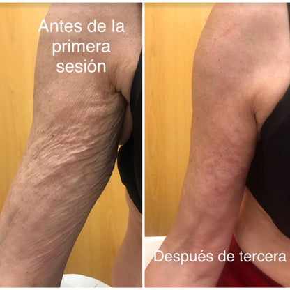 CeluliTech™ -  Elimina la celulitis y reafirma tu piel desde casa. *(Oferta Pre-Verano) +Envío GRATIS.